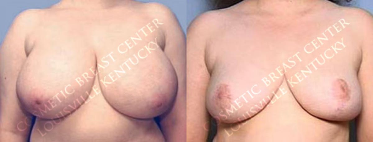 Reduction Before & After Gallery - Patient 294454 - Image 1