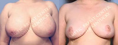 Reduction Before & After Gallery - Patient 294454 - Image 1