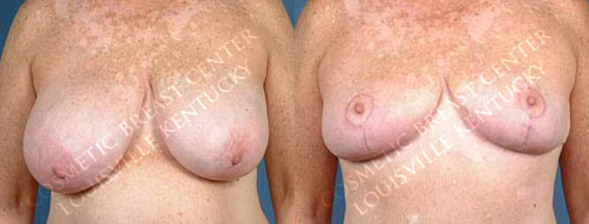 Reduction Before & After Gallery - Patient 368197 - Image 1