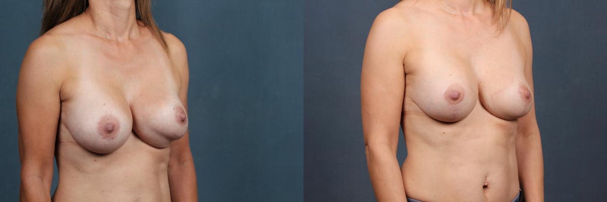 Revision Before & After Gallery - Patient 286833 - Image 3