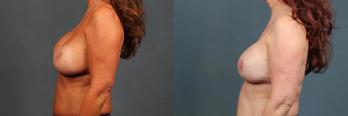 Revision Before & After Gallery - Patient 369130 - Image 2