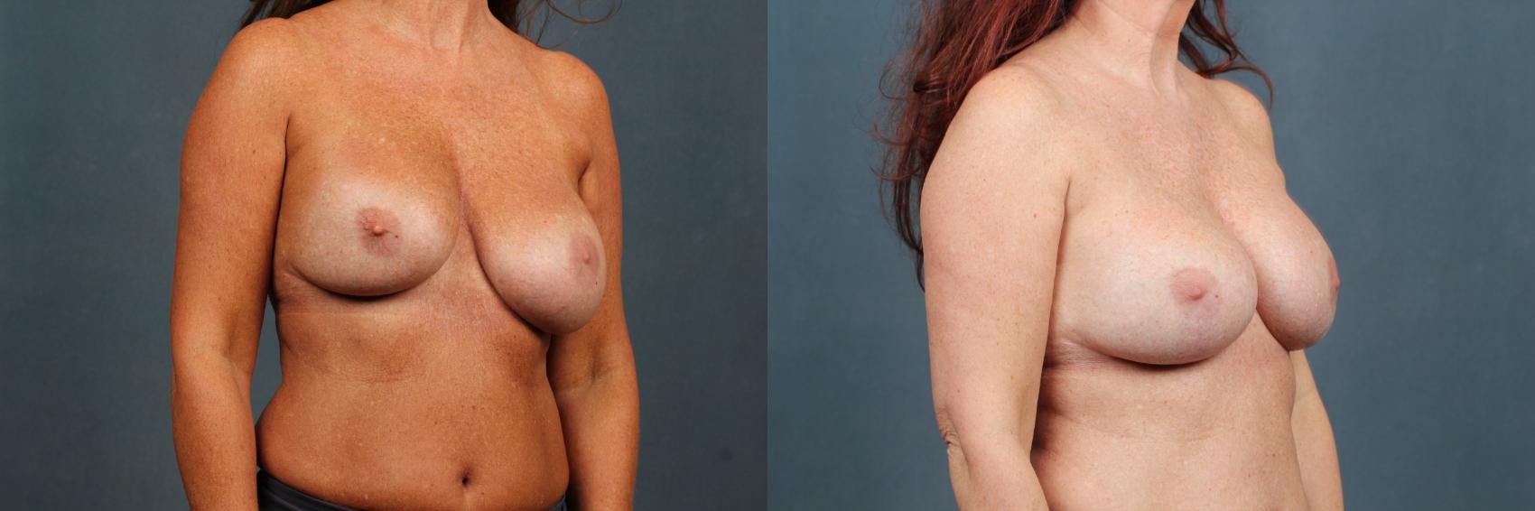 Revision Before & After Gallery - Patient 369130 - Image 3