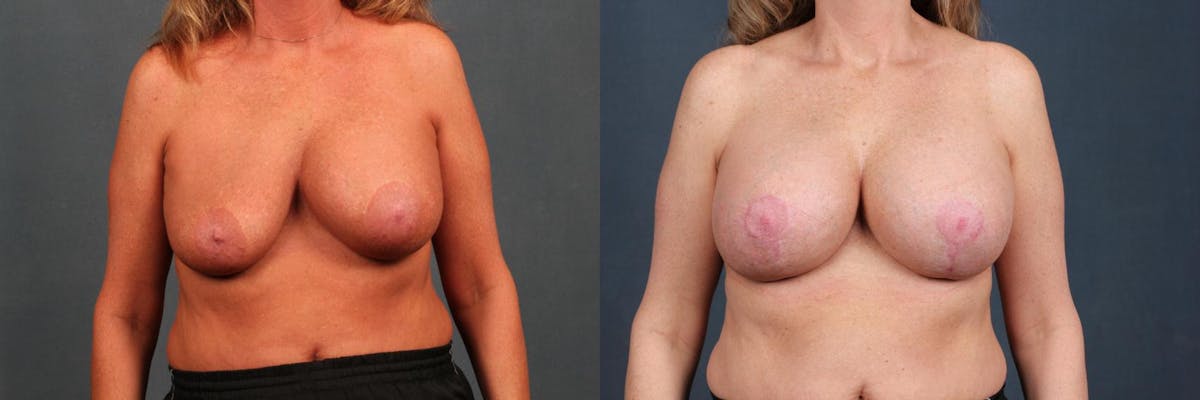 Revision Before & After Gallery - Patient 251627 - Image 1