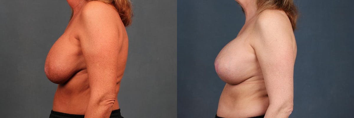 Revision Before & After Gallery - Patient 251627 - Image 3