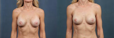 Revision Before & After Gallery - Patient 122100 - Image 1