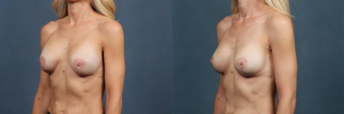 Revision Before & After Gallery - Patient 122100 - Image 2