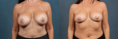 Revision Before & After Gallery - Patient 425300 - Image 1