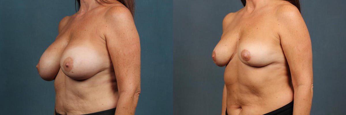 Revision Before & After Gallery - Patient 425300 - Image 2