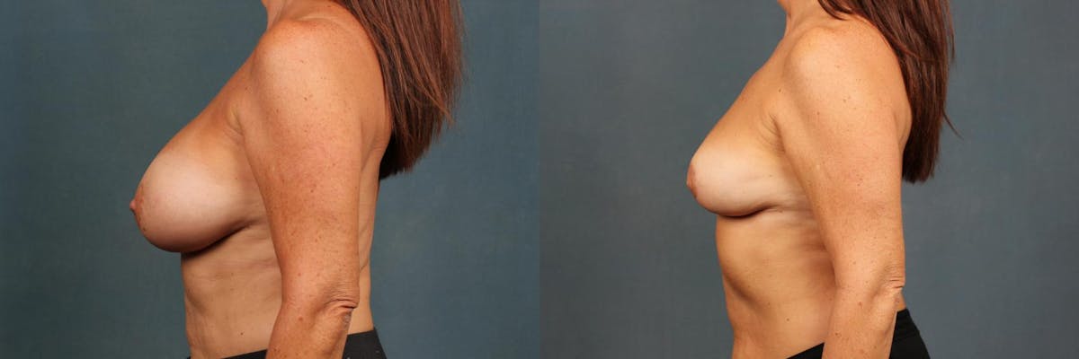 Revision Before & After Gallery - Patient 425300 - Image 3