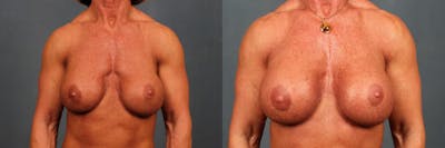 Revision Before & After Gallery - Patient 392230 - Image 1