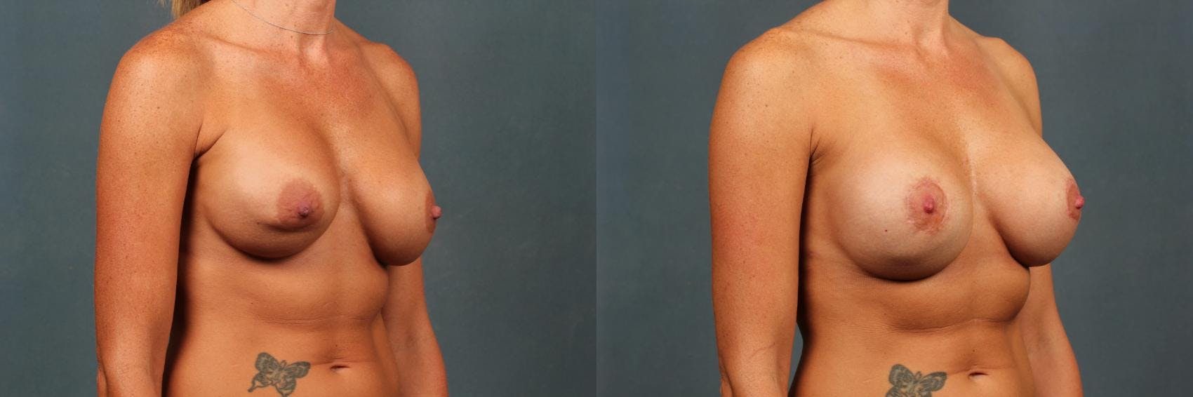 Revision Before & After Gallery - Patient 979513 - Image 2