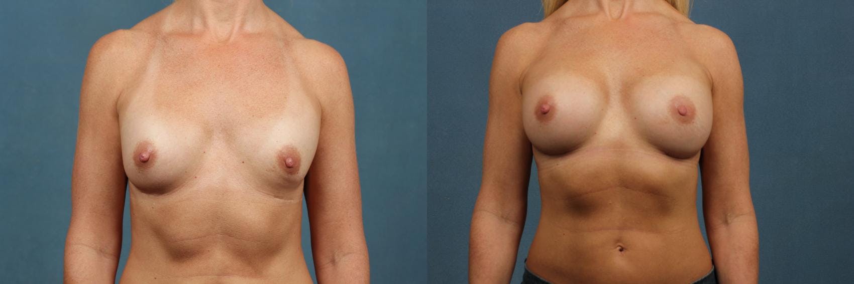 Revision Before & After Gallery - Patient 548989 - Image 1