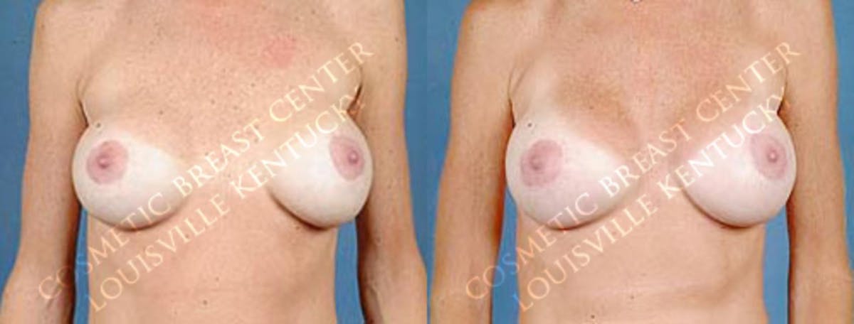 Revision Before & After Gallery - Patient 152932 - Image 1