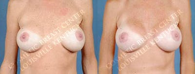 Revision Before & After Gallery - Patient 152932 - Image 1