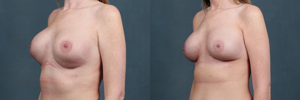 Revision Before & After Gallery - Patient 253465 - Image 2