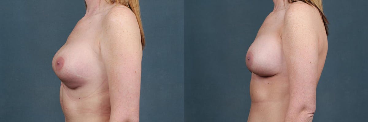 Revision Before & After Gallery - Patient 253465 - Image 3