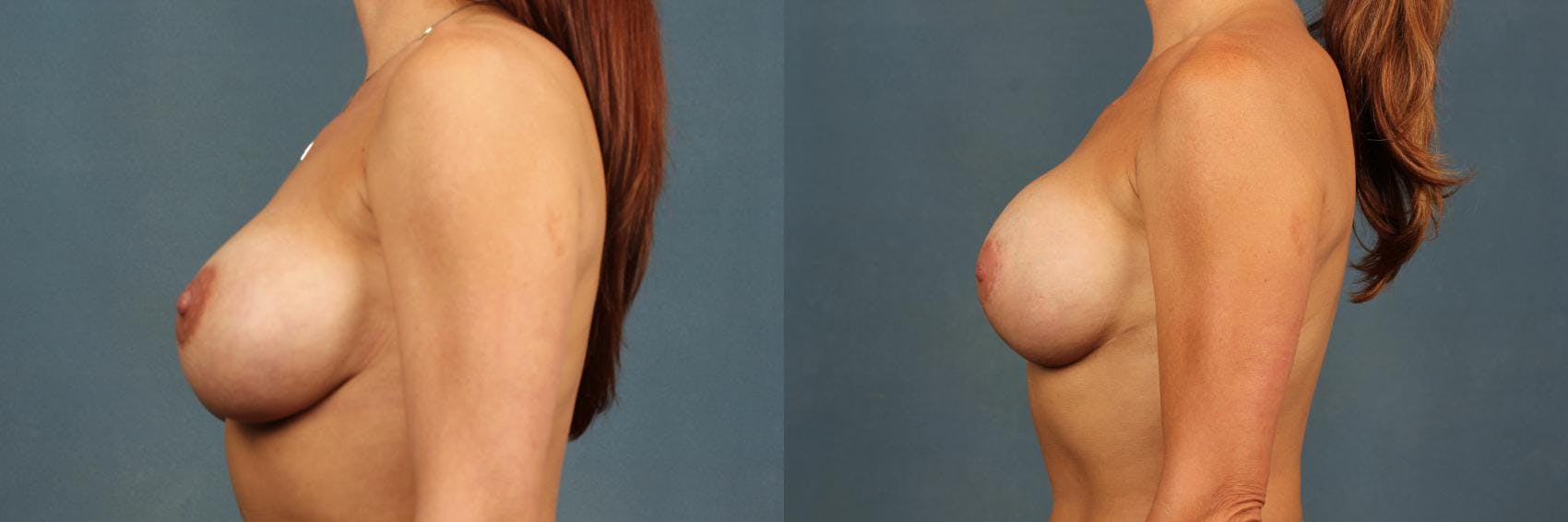 Revision Before & After Gallery - Patient 557331 - Image 3