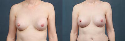 Revision Before & After Gallery - Patient 349076 - Image 1