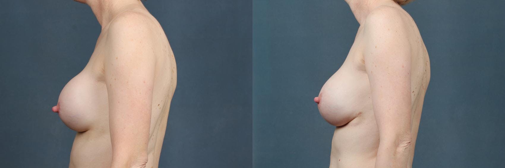 Revision Before & After Gallery - Patient 349076 - Image 3