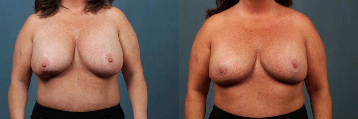 Revision Before & After Gallery - Patient 188046 - Image 1