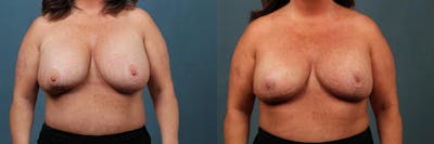 Revision Before & After Gallery - Patient 188046 - Image 1