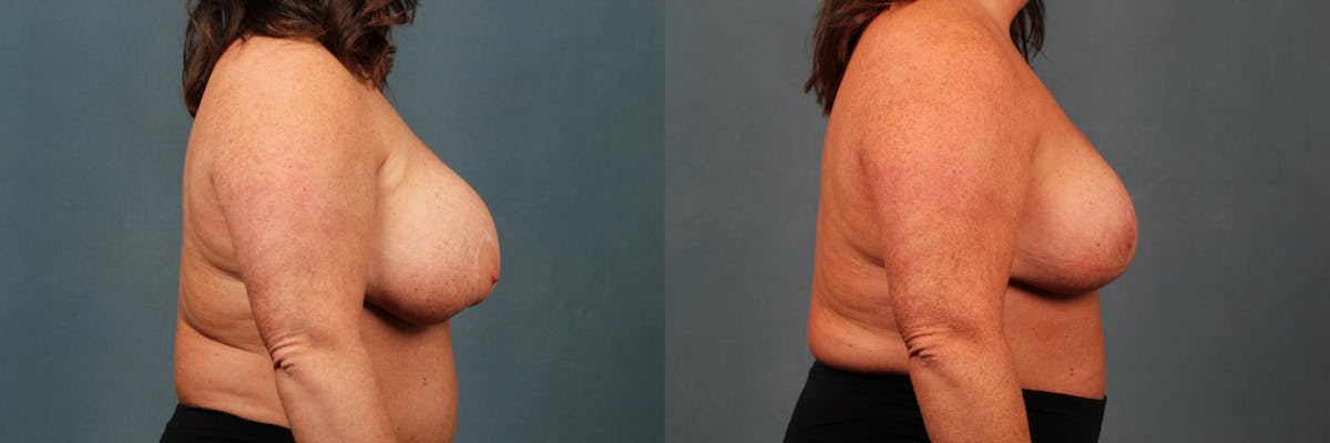 Revision Before & After Gallery - Patient 188046 - Image 3