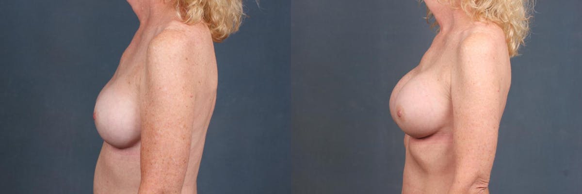 Revision Before & After Gallery - Patient 611858 - Image 3