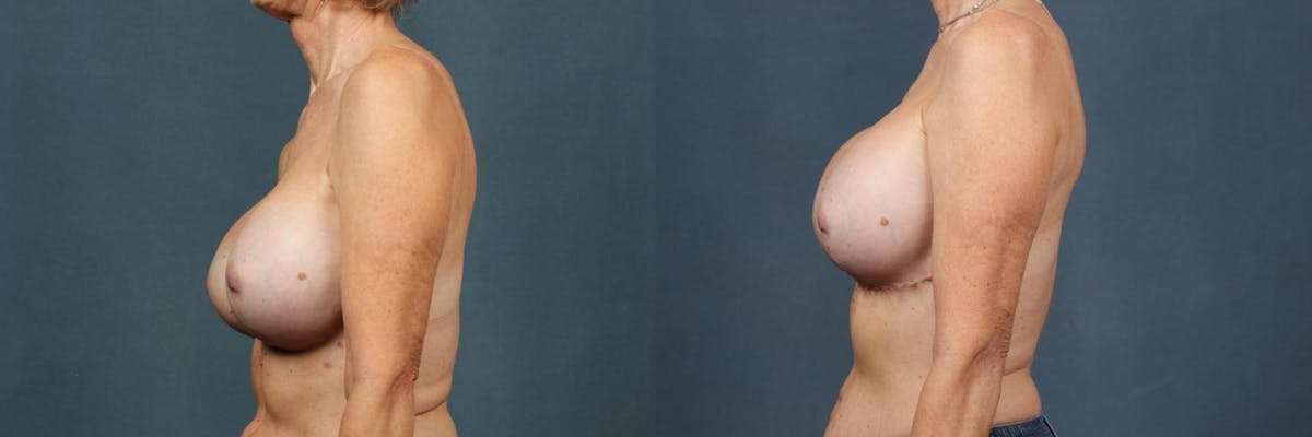 Revision Before & After Gallery - Patient 202988 - Image 3