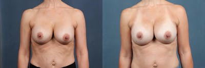 Revision Before & After Gallery - Patient 308148 - Image 1