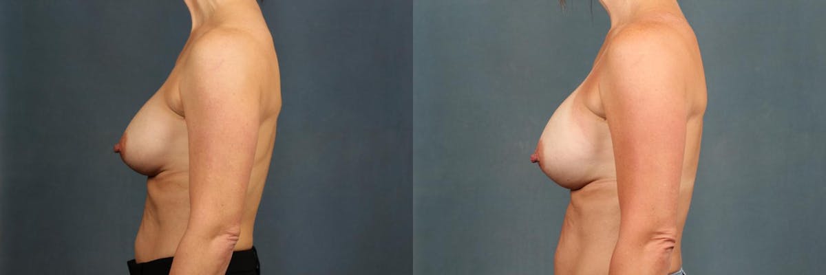 Revision Before & After Gallery - Patient 308148 - Image 3