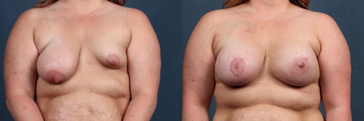 Revision Before & After Gallery - Patient 227658 - Image 1