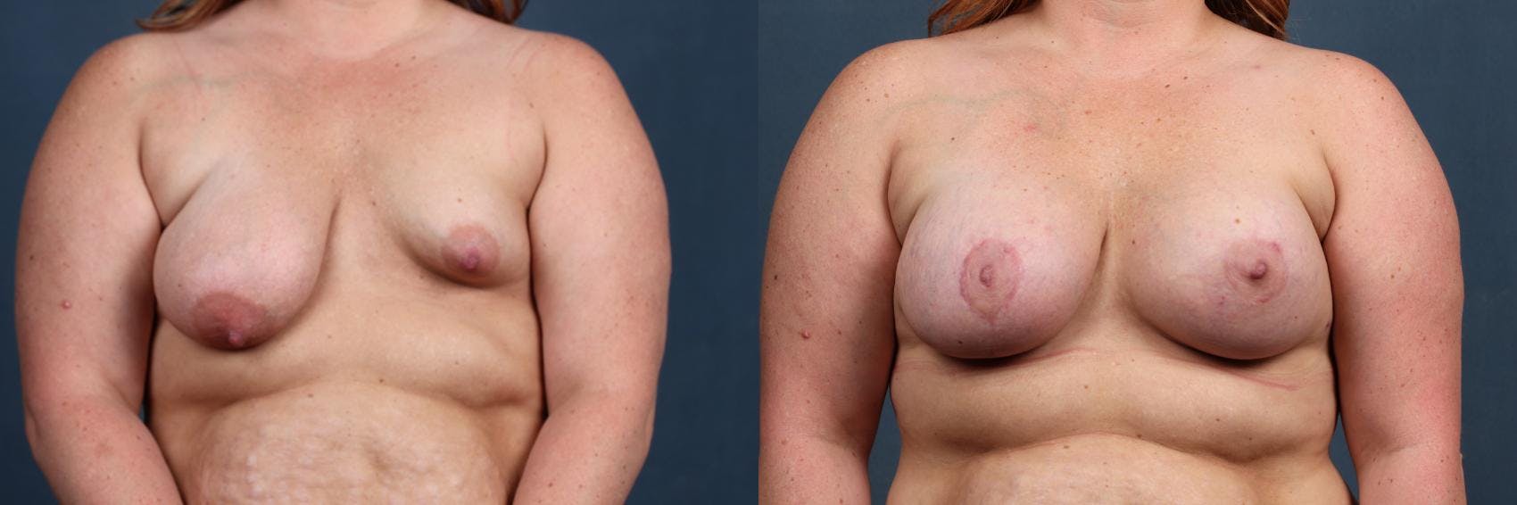 Revision Before & After Gallery - Patient 227658 - Image 1