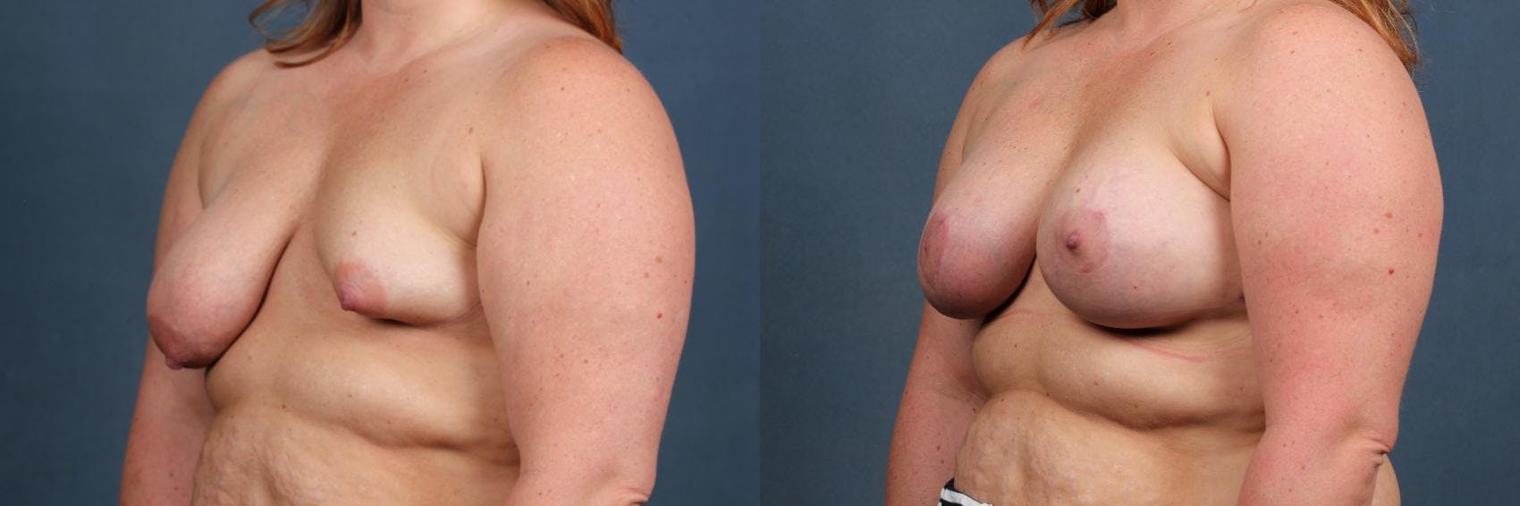 Revision Before & After Gallery - Patient 227658 - Image 2