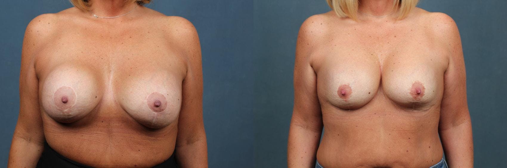 Revision Before & After Gallery - Patient 372144 - Image 1