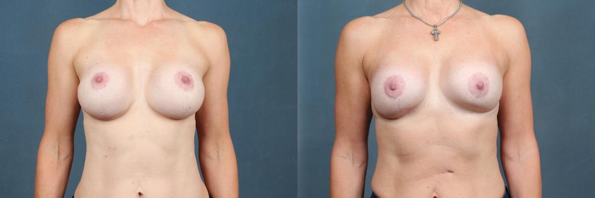 Revision Before & After Gallery - Patient 304102 - Image 1