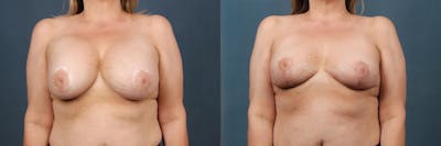 Revision Before & After Gallery - Patient 101807 - Image 1