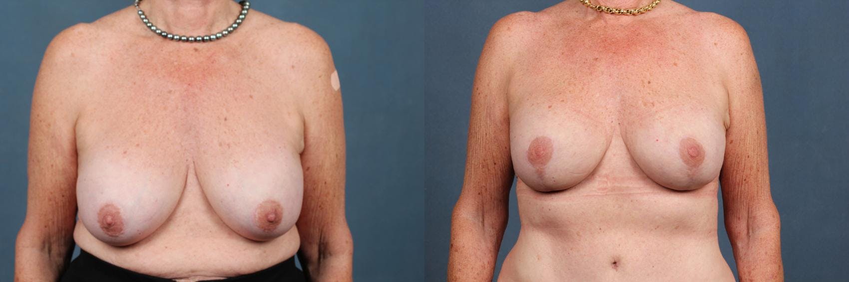 Revision Before & After Gallery - Patient 134375 - Image 1