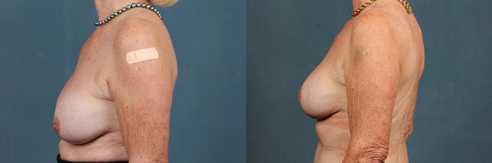 Revision Before & After Gallery - Patient 134375 - Image 3