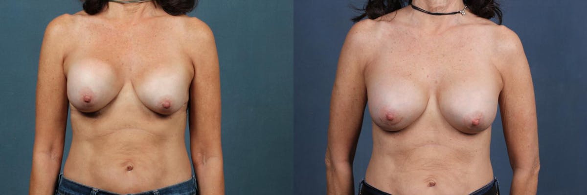 Revision Before & After Gallery - Patient 248192 - Image 1