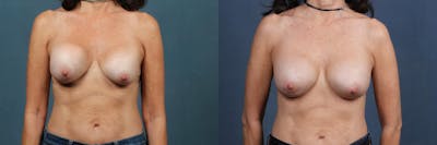 Revision Before & After Gallery - Patient 248192 - Image 1