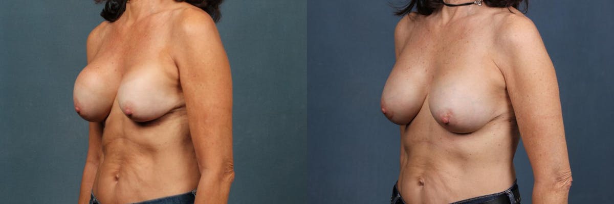 Revision Before & After Gallery - Patient 248192 - Image 2