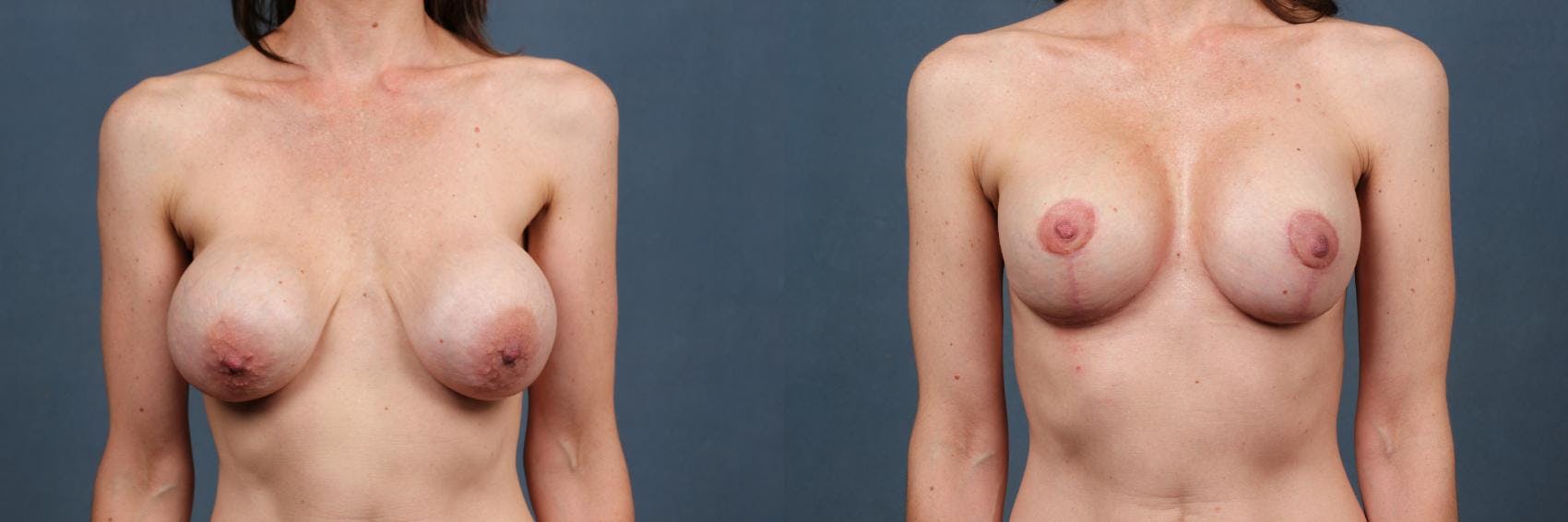 Revision Before & After Gallery - Patient 676211 - Image 1