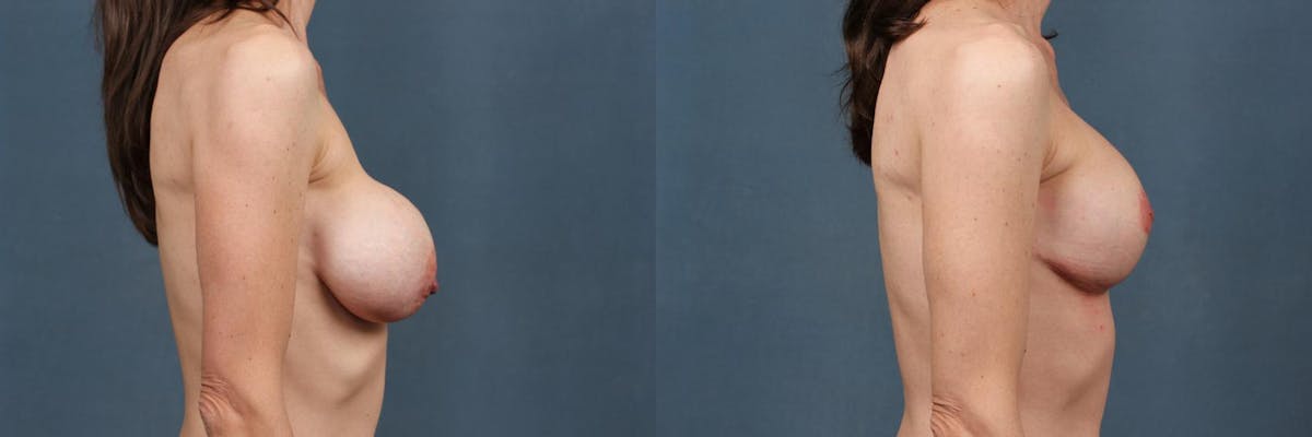 Revision Before & After Gallery - Patient 676211 - Image 3