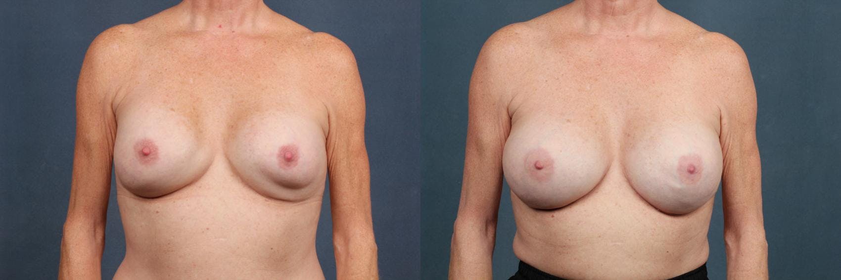 Revision Before & After Gallery - Patient 602022 - Image 1