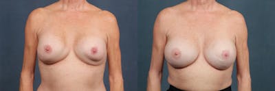 Revision Before & After Gallery - Patient 602022 - Image 1