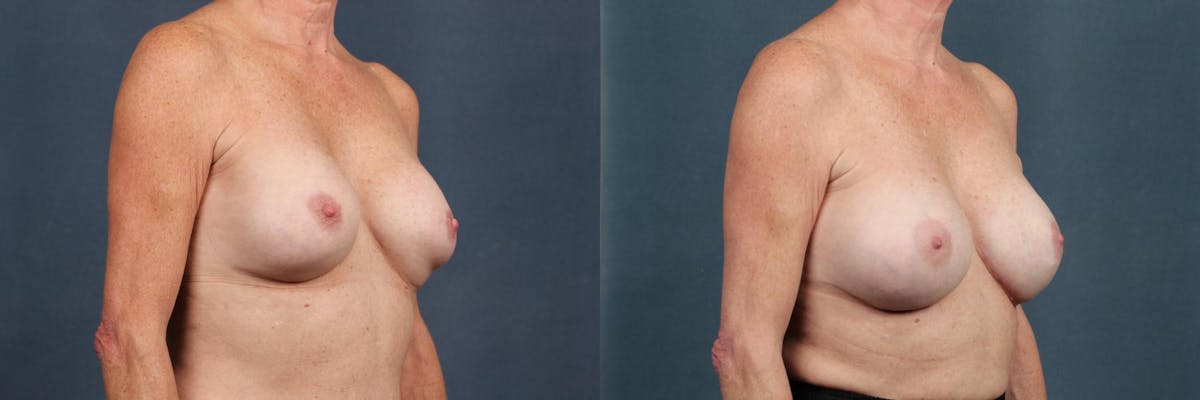 Revision Before & After Gallery - Patient 602022 - Image 3