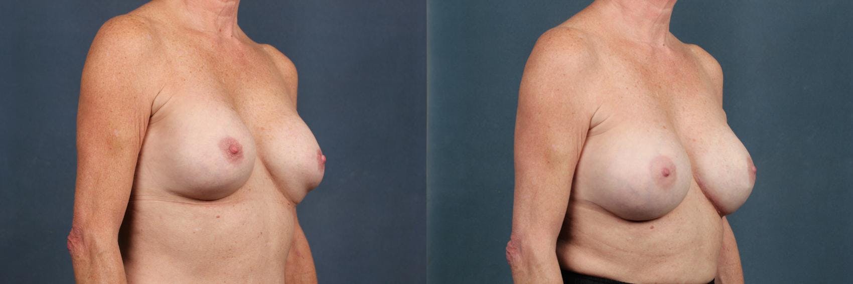 Revision Before & After Gallery - Patient 602022 - Image 3