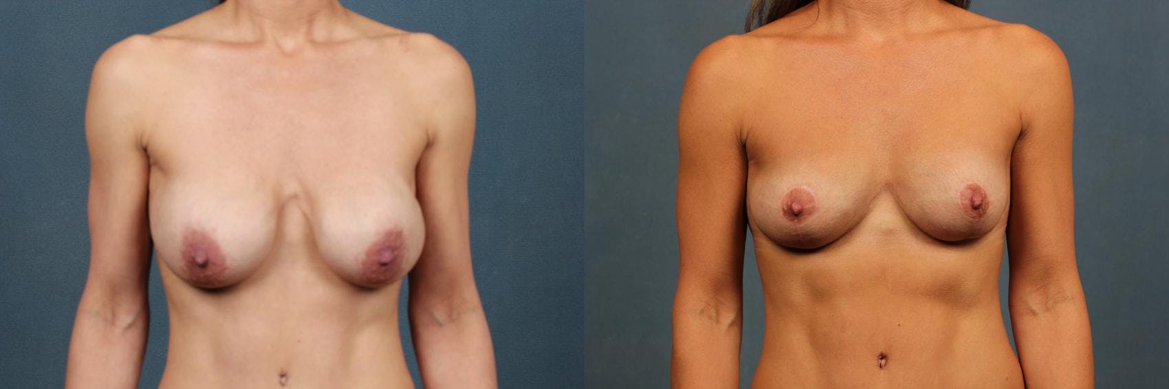 Revision Before & After Gallery - Patient 341311 - Image 1