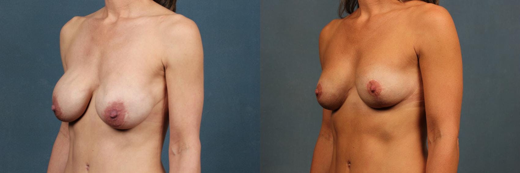 Revision Before & After Gallery - Patient 341311 - Image 2