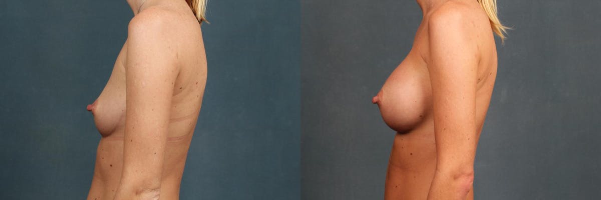 Revision Before & After Gallery - Patient 103122 - Image 3